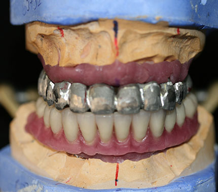 estudio protesico dental casos