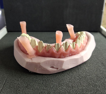 estudio protesico dental casos