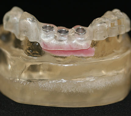 estudio protesico dental casos