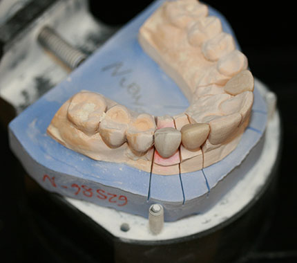 estudio protesico dental casos